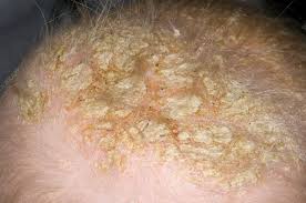 Image result for Cradle Cap
