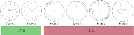 2 points for a normal clock or 0 (zero) points for an abnormal clock drawing. Automatic Dementia Screening And Scoring By Applying Deep Learning On Clock Drawing Tests Scientific Reports