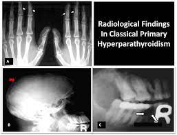 Primary Hyperpt A Xray Of The Hands Showing Subperiosteal Bone Resorption Over The Middle Phalanges White Arr Radiology Imaging Primary Parathyroid Disease