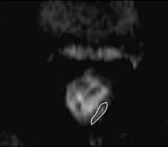 Magnetic resonance imaging in locally advanced rectal cancer: quantitative  evaluation of the complete response to neoadjuvant th
