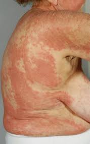 Image result for Pemphigoid