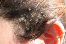 A dry and itchy scalp is the most common hair problem for both men and women and the causes are numerous. Scalp Eczema Symptoms Treatment And Remedies