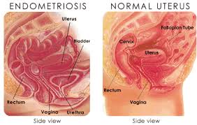 Drs Jp Prinsloo Inc Endometriosis Endometriosis Awareness Endometriosis Awareness Month