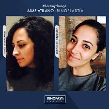 Rinoplastia en Ciudad Juárez y EL Paso, TX