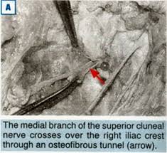 There can also be a radiation of pain into the buttocks or hip. Superior Cluneal Nerve Entrapment An Overlooked Cause Of Low Back Pain