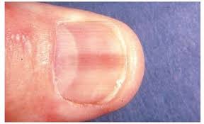 diseases of the nail part 2