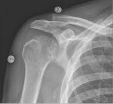 Image result for Osteomyelitis XRay