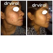 Top Wrinkle Reduction Treatment in Ghuma