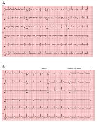 Ecg Abnormalities Can Predict Covid 19 Mortality