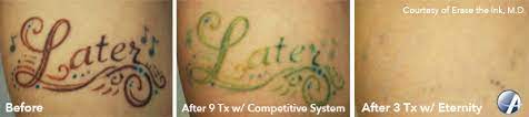 Maybe you would like to learn more about one of these? Laser Tattoo Removal In San Antonio Texas Astanza Laser