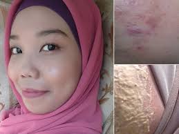 Bekas jerawat terbagi menjadi dua: Wajah Penuh Parut Jerawat Tapi Kembali Mulus Lepas Seminggu Amal Petua Ini Vanilla Kismis