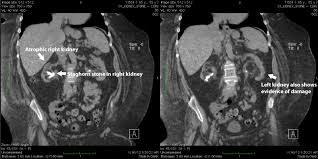 Can Kidney Stones Cause Kidney Failure Or Damage Kidneystoners Org