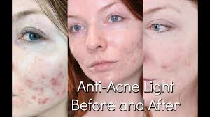 Bluemd Light Therapy Review Trophy Skin Before After Youtube
