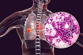 Chest pain and pain under the left rib caused by angina are often mistaken for heartburn or a heart attack. Proteomic Map Of Human Lung Adenocarcinoma Revealed