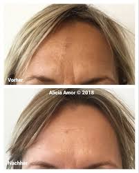 Wer mit dem gedanken spielt, seine falten die glättung der querfalte auf der stirn kostet bei dermedis zum beispiel 199 euro. Facebook