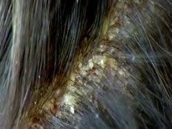 The goal is to have hair that is vibrant, healthy and full. Managing Scalp Psoriasis And Your Natural Black Hair Scalp Psoriasis Treatment Scalp Psoriasis Psoriasis Remedies Scalp