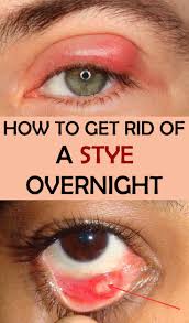 How To Get Rid Of A Stye Overnight Beauty Tipszone Com Eye Stye Remedies Stye Remedy Get Rid Of Stye