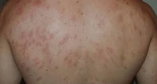 Acestea sunt însoțite de hemoragie a vaselor de sânge din piele fără pauze, adesea acest simptom nu este luat în considerare. Pete Rosii Talpa Dr Adrian Ilonca