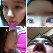 Also antibiotics may be required to reduce swelling and redness. Real Story Get Rid Of The Face Of Extraordinary Jw Plastic Surgery