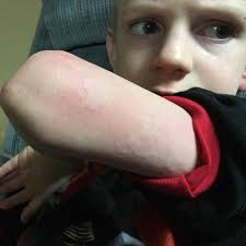 Bintik merah pada kulit dan gatal akibat penyakit autoimun psoriasis. 7 Gejala Biduran Atau Kaligata Beserta Tips Untuk Mencegahnya Ragam Bola Com