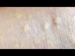 Relax Every Day With Sac Dep Spa 0080 Youtube In 2021 Zits Popping Spa Blackheads Popping