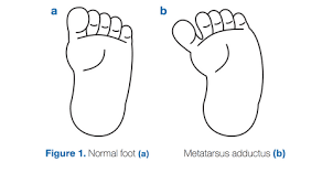 Image result for In-Toeing