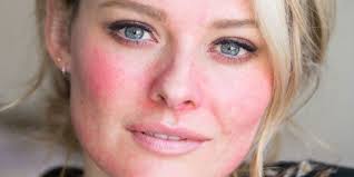 Jagger Addresses Rosacea Awareness