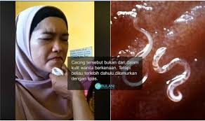 Resdung atau sinusitis merupakan sejenis penyakit di mana rongga sinus mengalami keradangan yang disebabkan oleh jangkitan kuman. Tidak Pernah Tercatat Dalam Mana Mana Kitab Perubatan Doktor Rungkai Rawatan Resdung Keluar Cacing Dari Muka