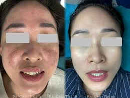 👉ĐIỀU TRỊ NÁM