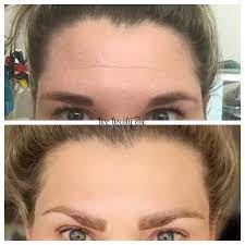 I recommend that my patients come back every 3.5 months so that they have their next injection before the previous botox has completely worn off. Botox Before And After My Botox Experience