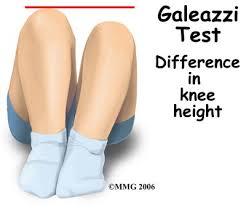 Gallery For Galeazzi Sign Developmental Dysplasia Of The Hip Hip Dysplasia Pediatric Physical Therapy