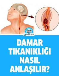 Damar Tikanikligi Nasil Anlasilir Belirtileri Nelerdir Saglik Saglik Saglik Ipuclari Saglikli Yasam Tarzi
