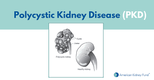Polycystic Kidney Disease Pkd Symptoms Treatments Causes American Kidney Fund Akf