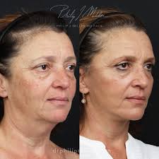 1 Rhinoplasty & Facelift Surgeon in New York
