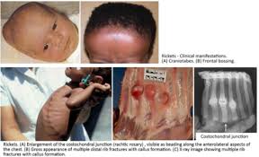 Image result for Craniotabes