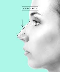 Additionally, it will make an existing nasal hump on the. Nose Grow After Rhinoplasty Best Rhinoplasty