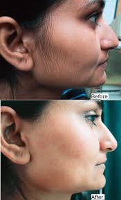 Women who are having lots of facial hair can do waxing. Homemade Facial Hair Removal Mask Alldaychic