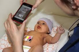 Jaundice occurs in about 60% of healthy term infants. New Smartphone App Can Detect Newborn Jaundice In Minutes Uw News
