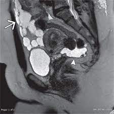 Malignant transformation of benign cystic mesothelioma of the peritoneum. Benign Multicystic Peritoneal Mesothelioma Airp Best Cases In Radiologic Pathologic Correlation Radiographics