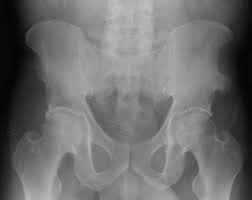 You may need to spend a few weeks on crutches if you have. Anterior Superior Iliac Spine Asis Avulsion Knee Sports Orthobullets