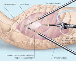 Lungenkrebs Bronchialkarzinom Risikofaktoren Symptome Behandlung
