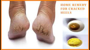 How To Get Rid Of Dry Cracked Heels Home Remedy For Cracked Heels Feet Youtube