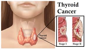 We did not find results for: How Will You Manage A Case Of Papillary Carcinoma Of 27 Year Old Male Presented With Solitary Thyroid Nodule Of 2cm In His Left Lower Pole Along With Multiple Ipsilateral Mobile Lymphonode