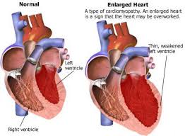 Left Ventricular Hypertrophy Google Search Enlarged Heart Heart Type Interventional Radiology