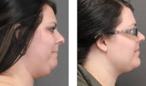 Body Surgery Before & After