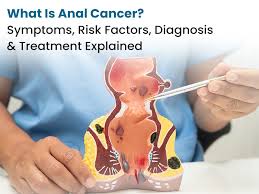 Image result for Anal Cancer