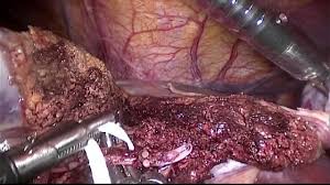The high fragmentation rate and the different effects on different types of tissue allow the surgeon to work safely and even quickly. Surgery International Laparoscopic Liver Society Video