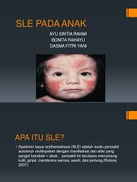 Penyakit multiple sclerosis memang tak sepopuler penyakit stroke dan kanker. Sle Pada Anak