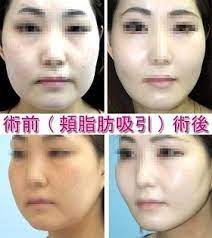 頬の脂肪吸引 脂肪吸引 頬 脂肪