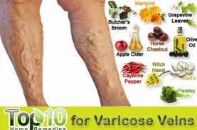 How do i healed my varicose veins? Varicose Veins Best Homemade Remedies The Whoot
